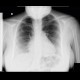 Replacement of pulmonary valve, Fallot's tetralogy: X-ray - Plain radiograph